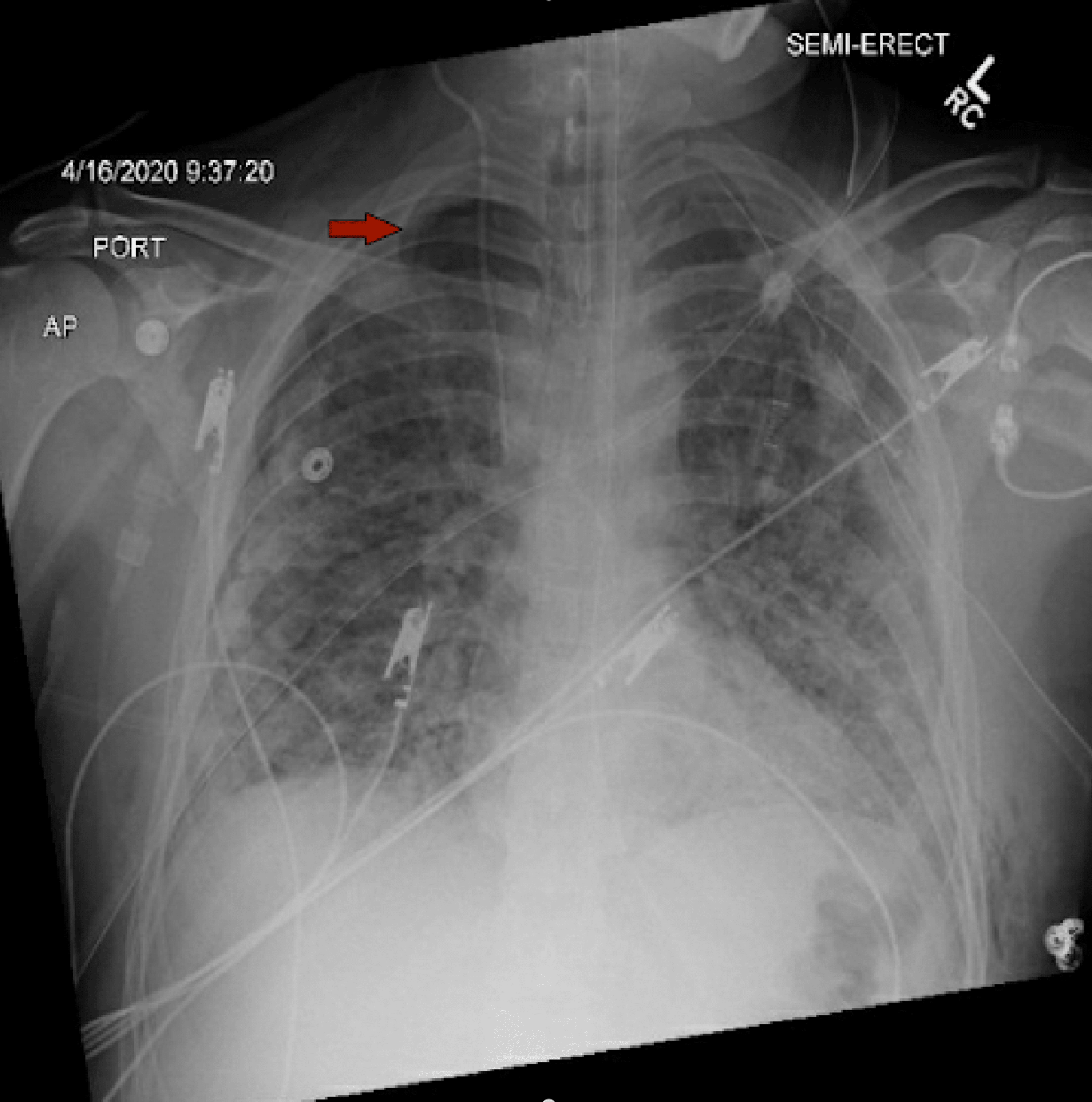 Cureus Pneumothorax in Intubated Patients With COVID19 A Case Series