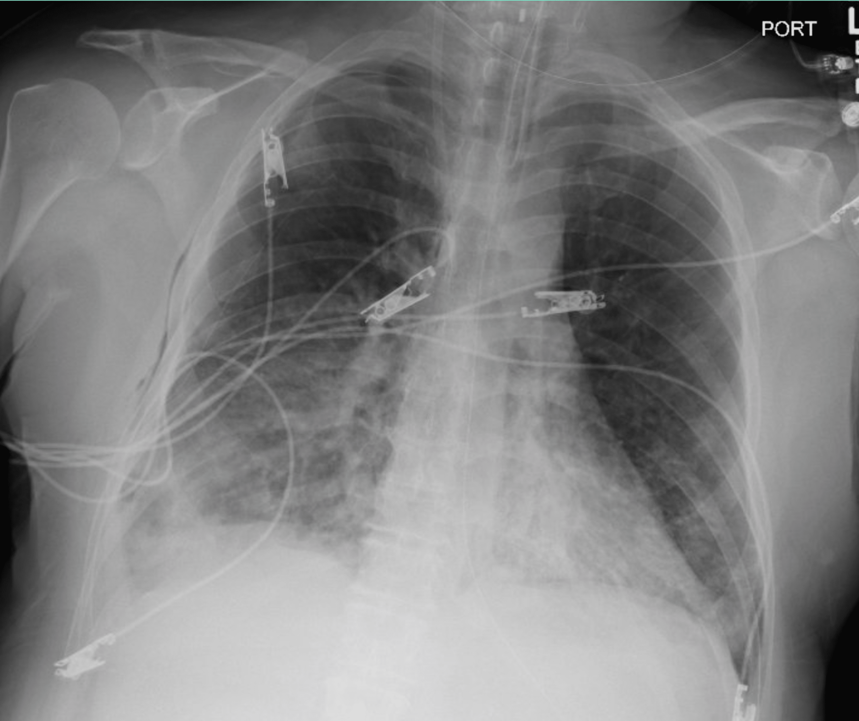 Cureus | Pneumothorax in Intubated Patients With COVID-19: A Case Series