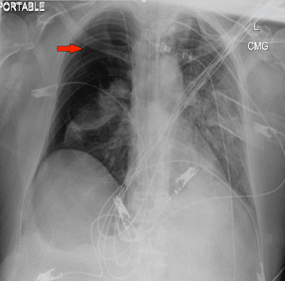 Cureus | Pneumothorax in Intubated Patients With COVID-19: A Case Series