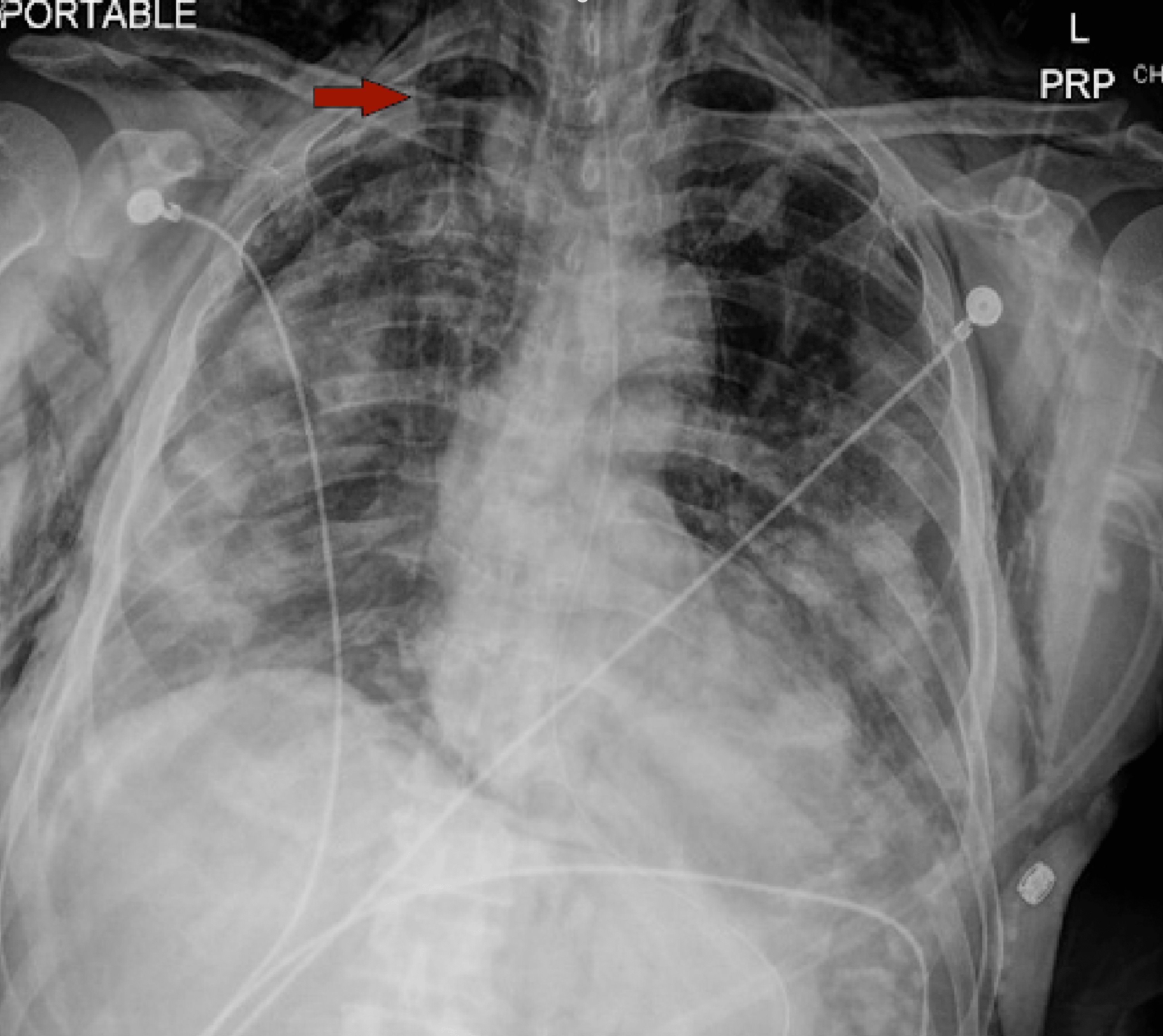 Cureus | Pneumothorax in Intubated Patients With COVID-19: A Case Series