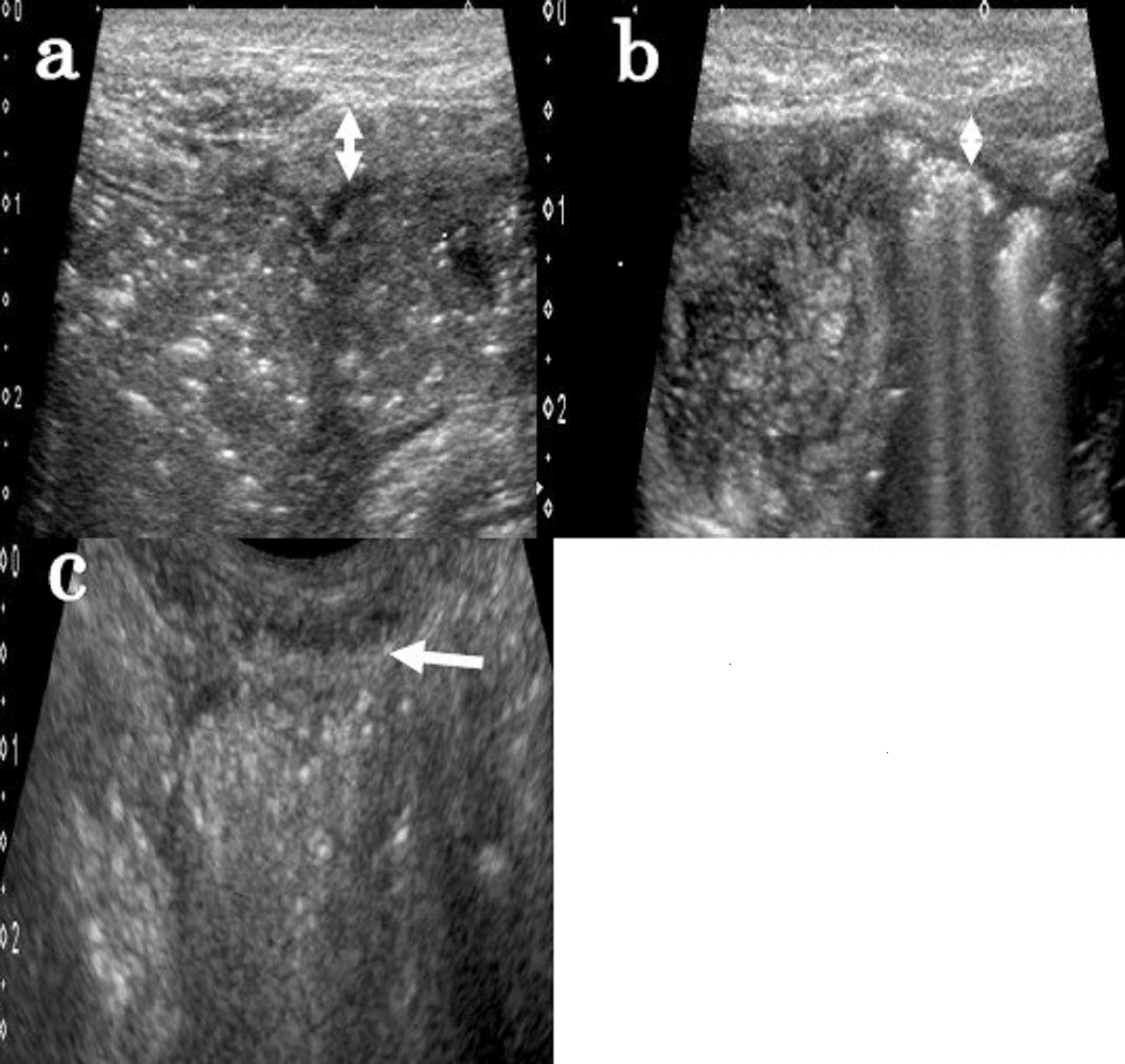 Cureus Spontaneous Resolution of Strangulated Small Bowel Obstruction