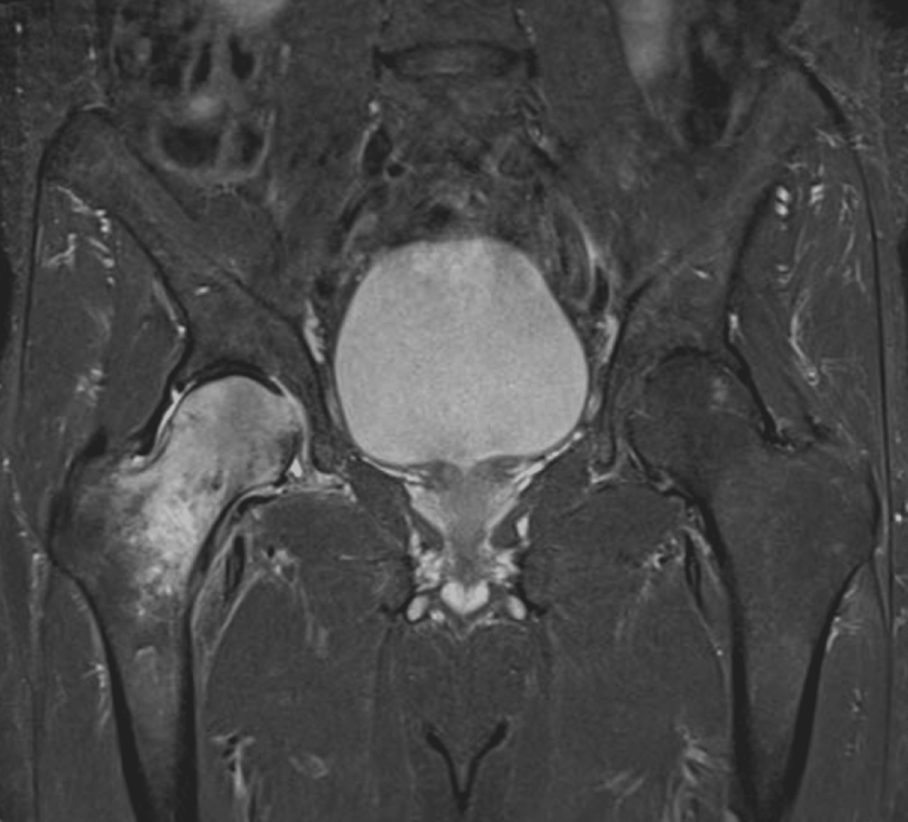 Prevalence of Transient Osteoporosis of the Hip Among Patients
