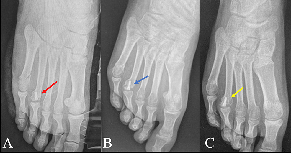 Cureus Acute Osteochondral Fracture Of The Metatarsal Head A Report Of Two Cases And Review