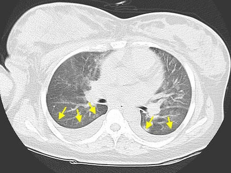 CT-image-of-the-chest