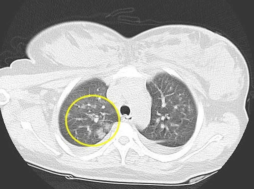 CT-image-of-the-chest