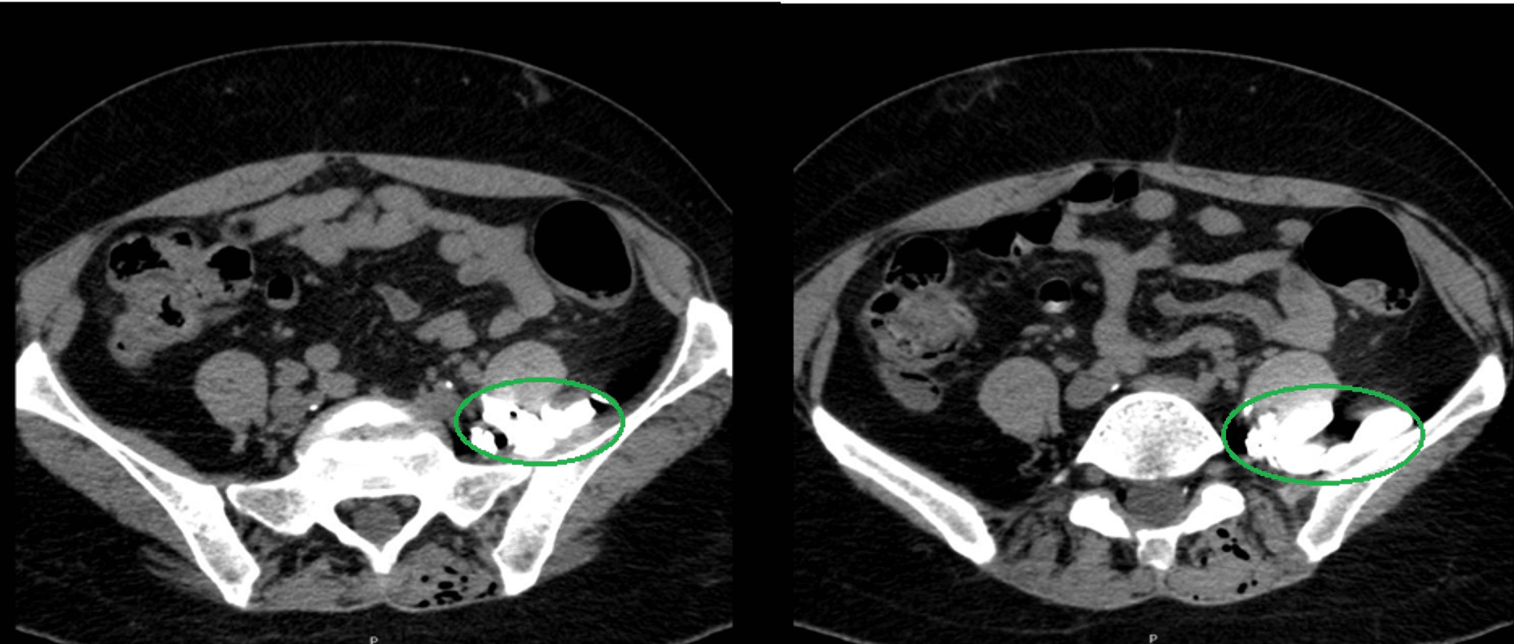 Cureus Epidural Catheter Migration A Case Report of a CT Scan