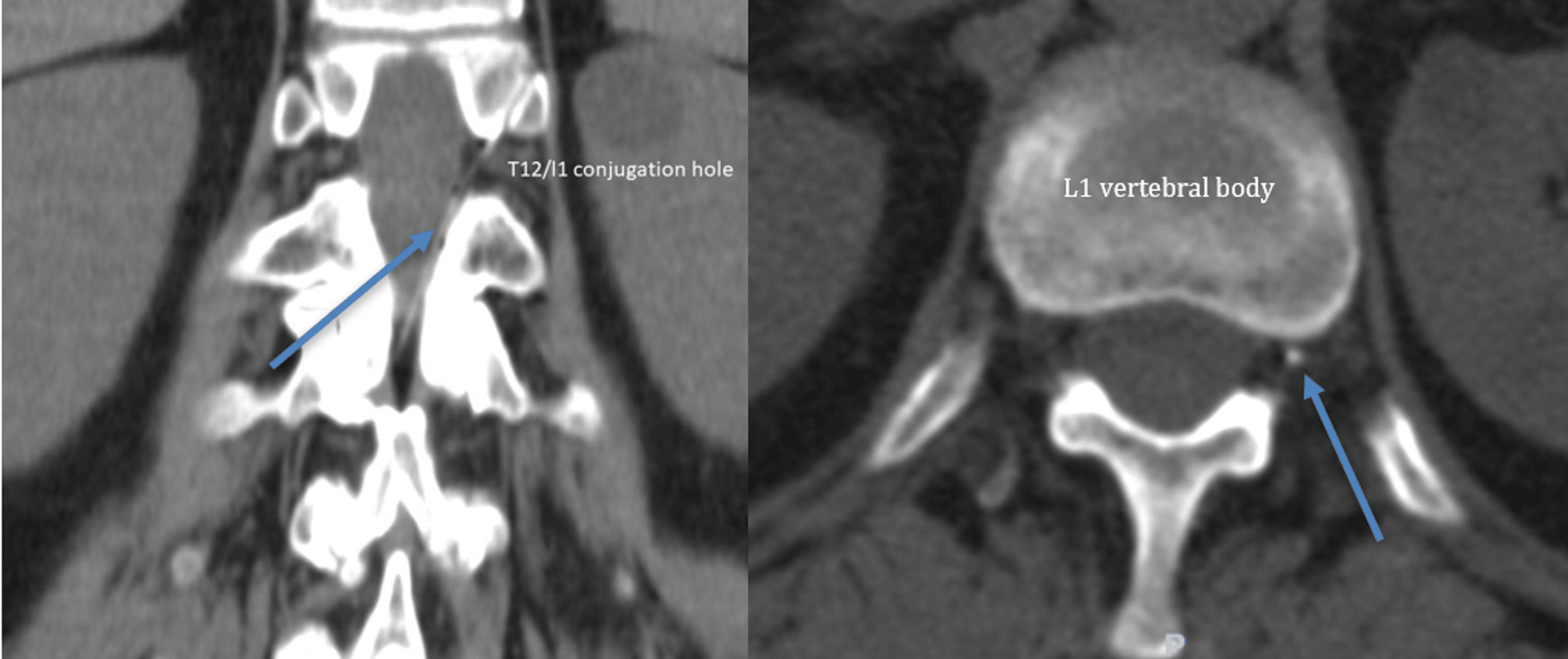 Epidural Catheter Migration A Case Report of a CT Scan Examination