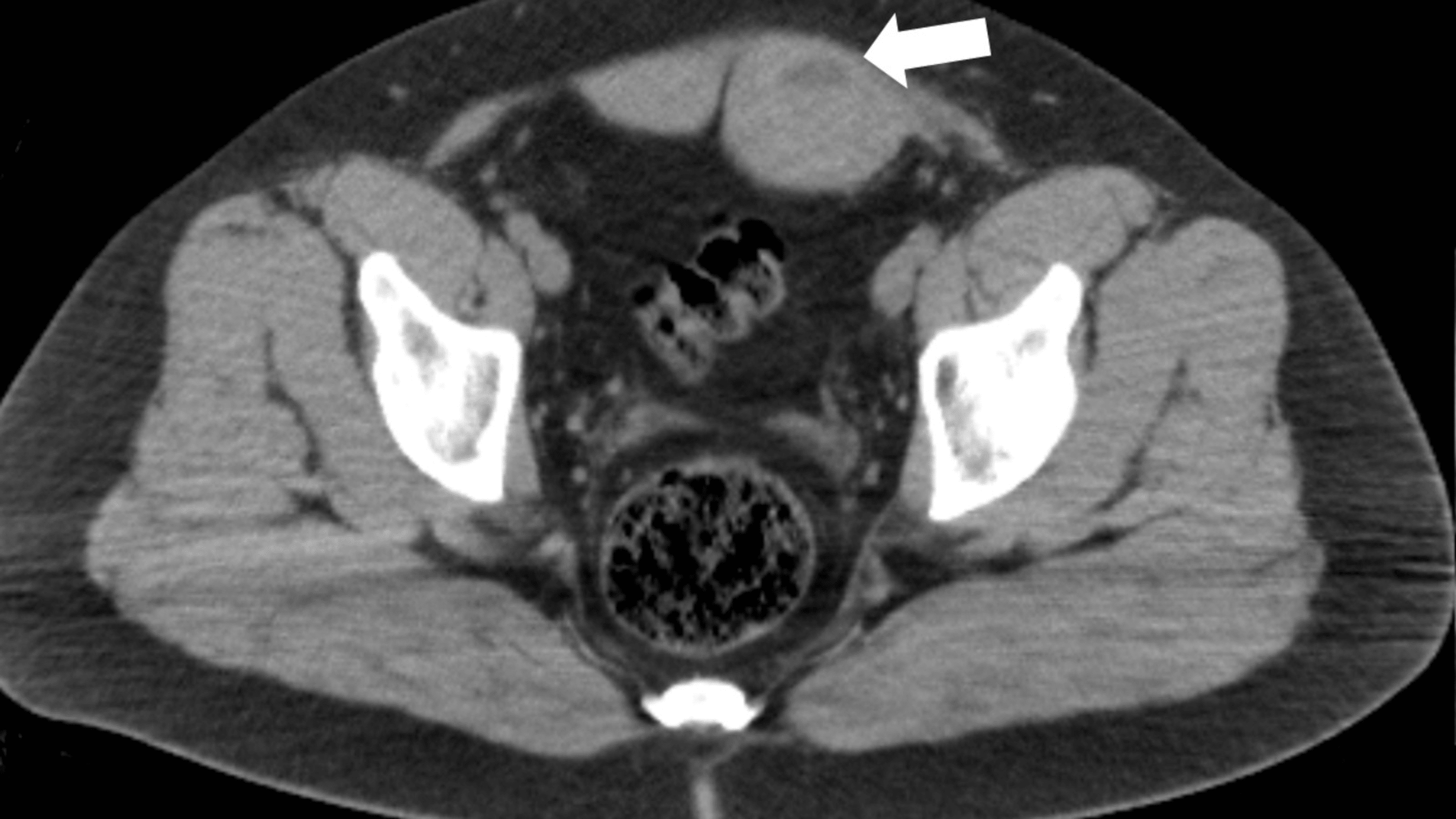 Rectus Sheath Hematoma as a Complication in Patients With COVID19