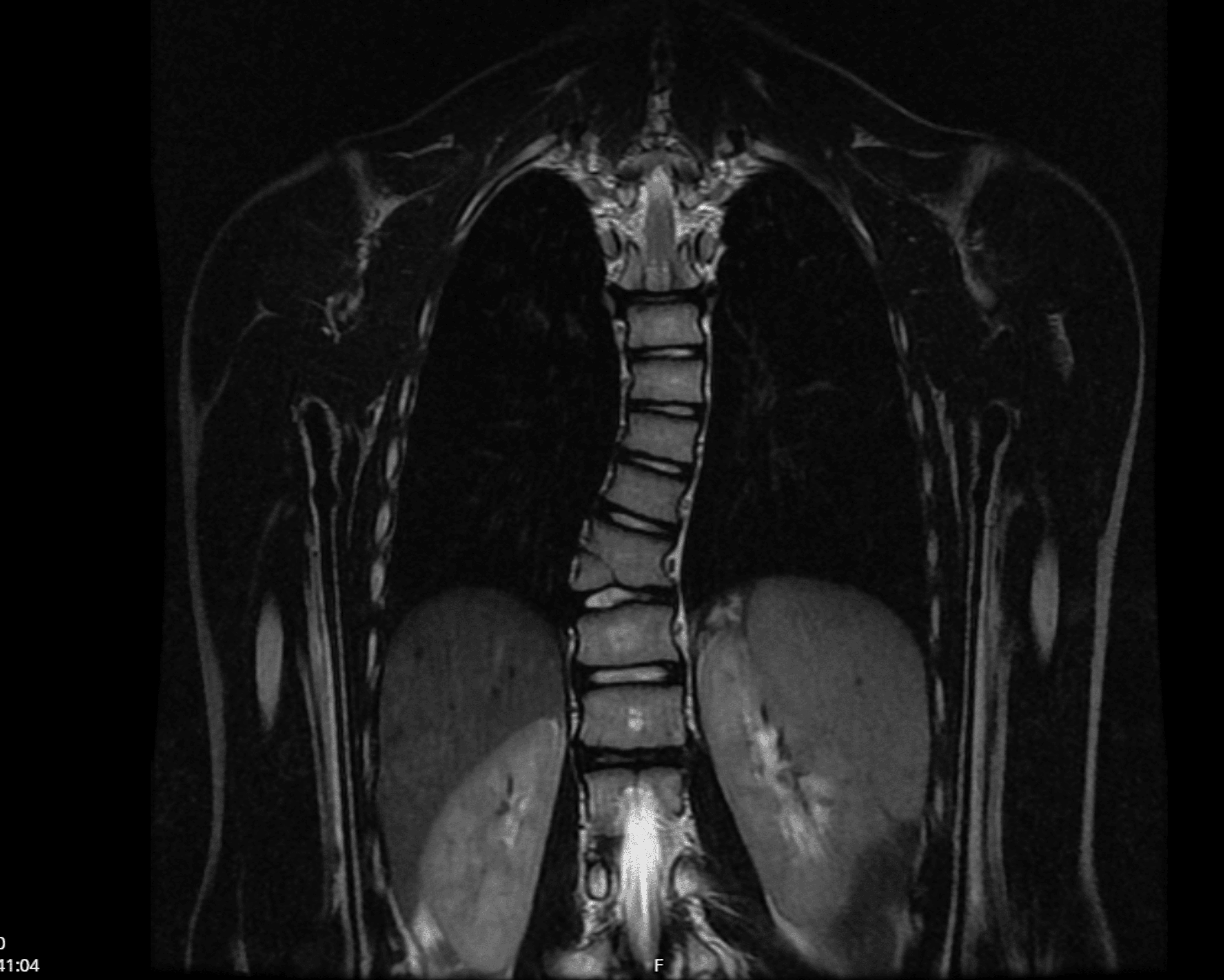 Cureus | Terminal 6q27 Microdeletion Syndrome: A Case Report