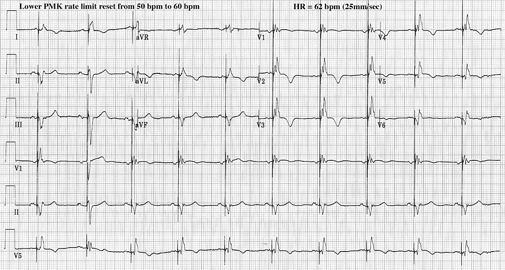 Sustained Suppression of Premature Ventricular Contractions by a ThreeMonth Pacing Adjustment