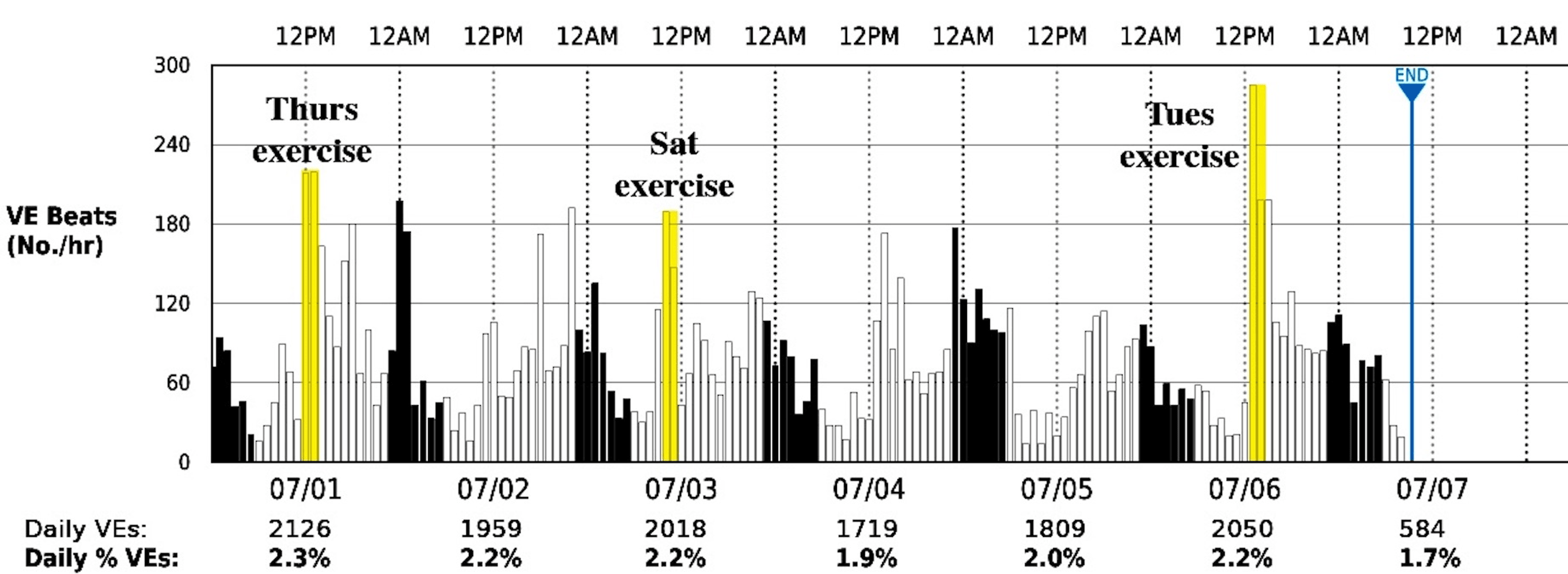 Cureus Sustained Suppression of Premature Ventricular Contractions by