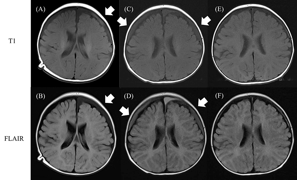 Brain-magnetic-resonance-imaging-of-the-patient