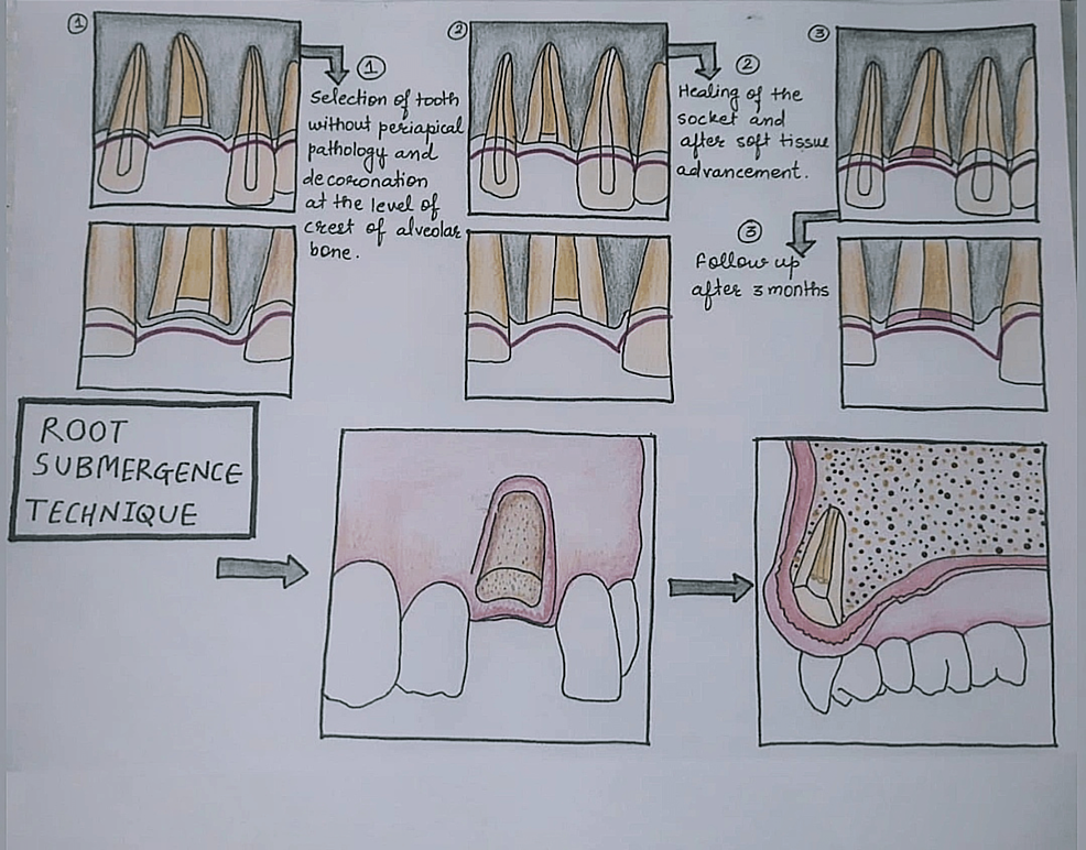 Partial Extraction Therapy for Implant Placement A Newer Approach in