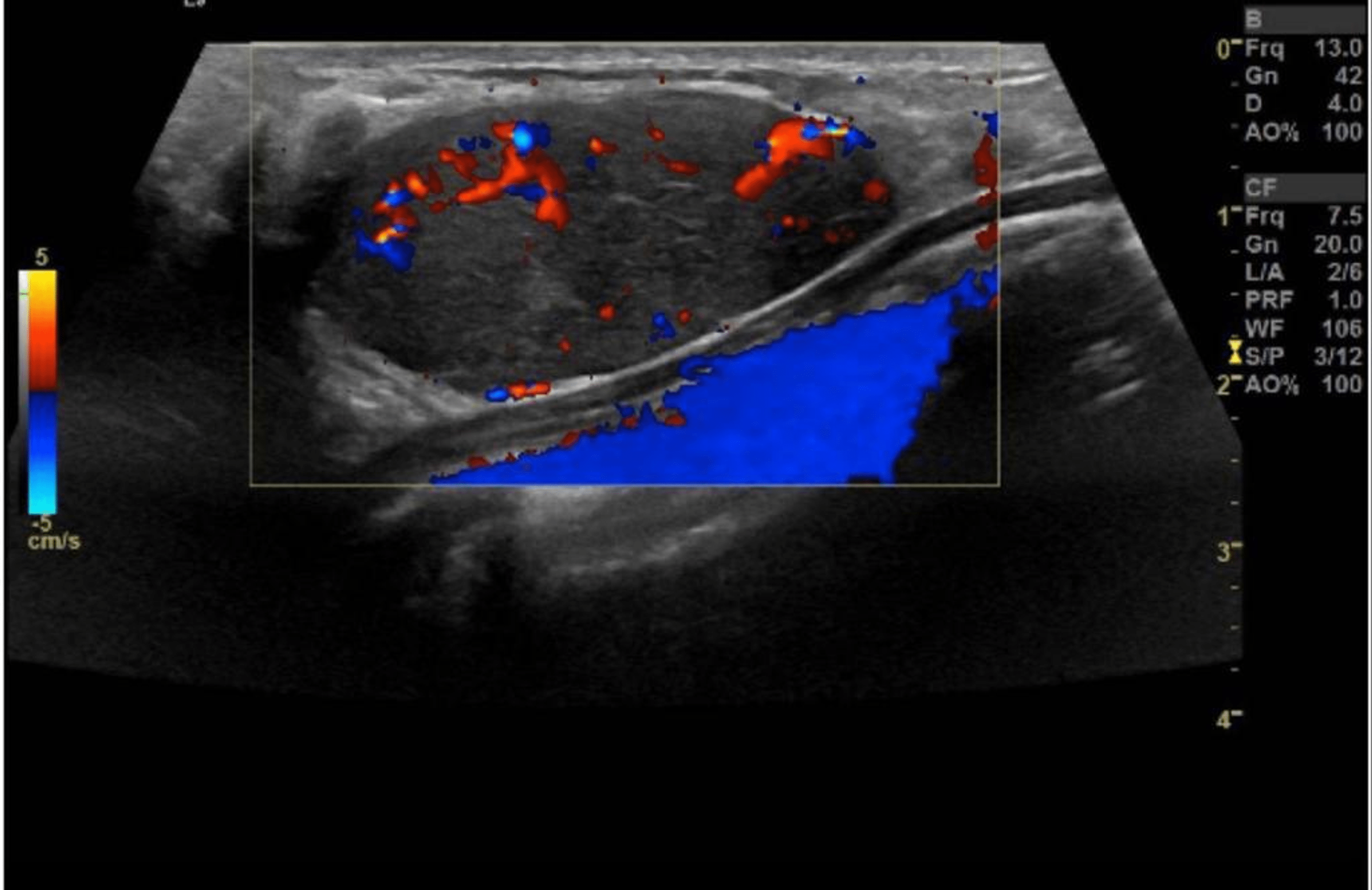 Cureus | Tubular Adenoma of the Breast Mimicking Fibroadenoma