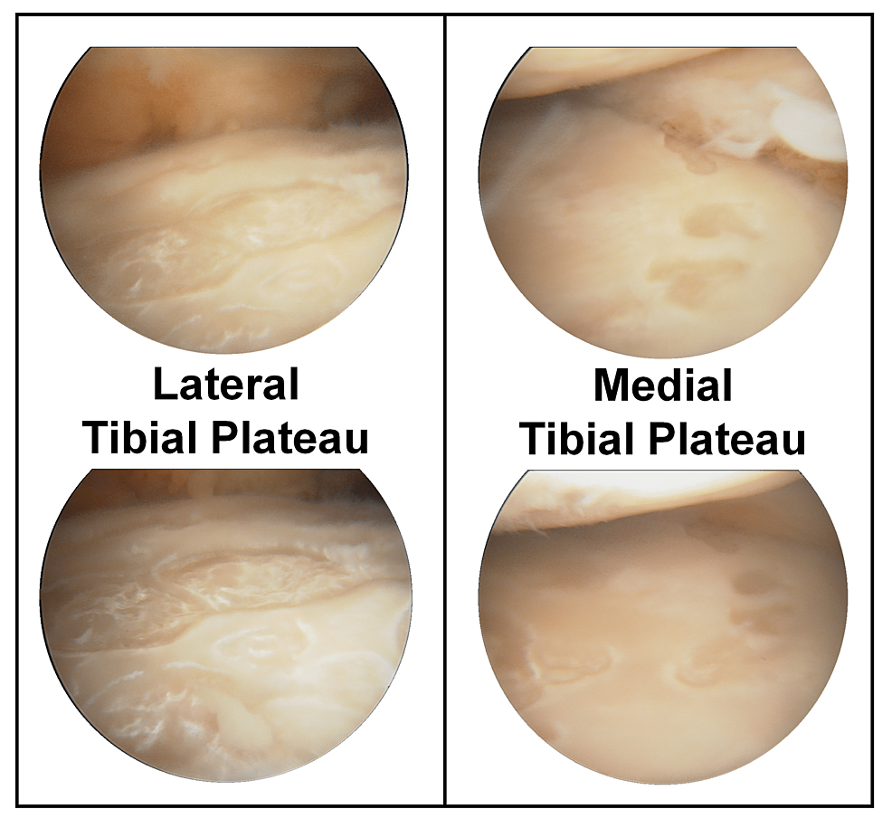 Native Knee Septic Arthritis Due To Cutibacterium Acnes A Case Report Cureus