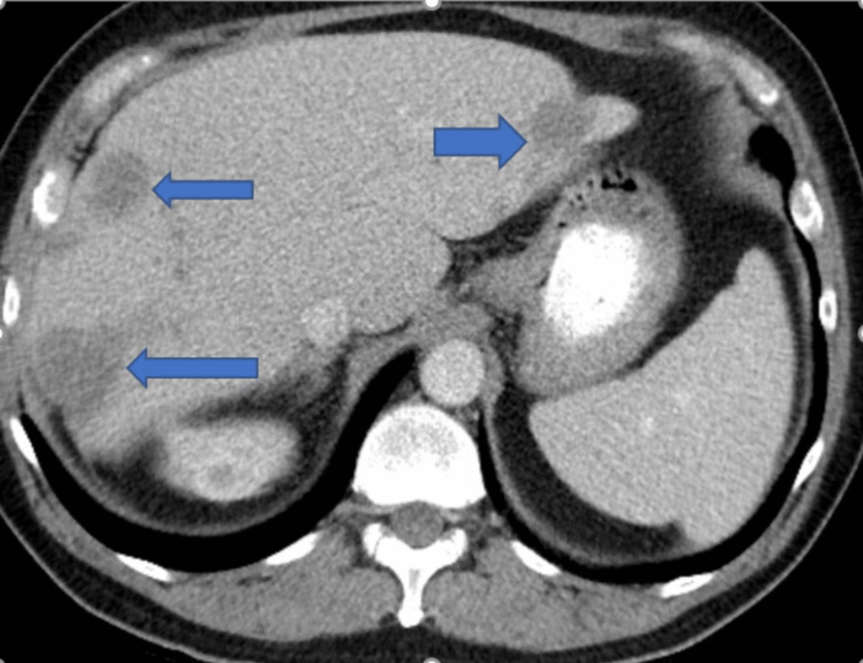 cureus-an-interesting-case-of-prostate-cancer-presenting-with-colonic