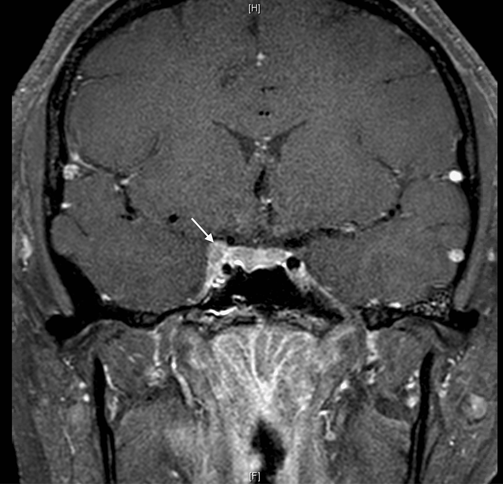 Stick a Needle in My Eye: A Case Report of Penetrating Needlefish ...
