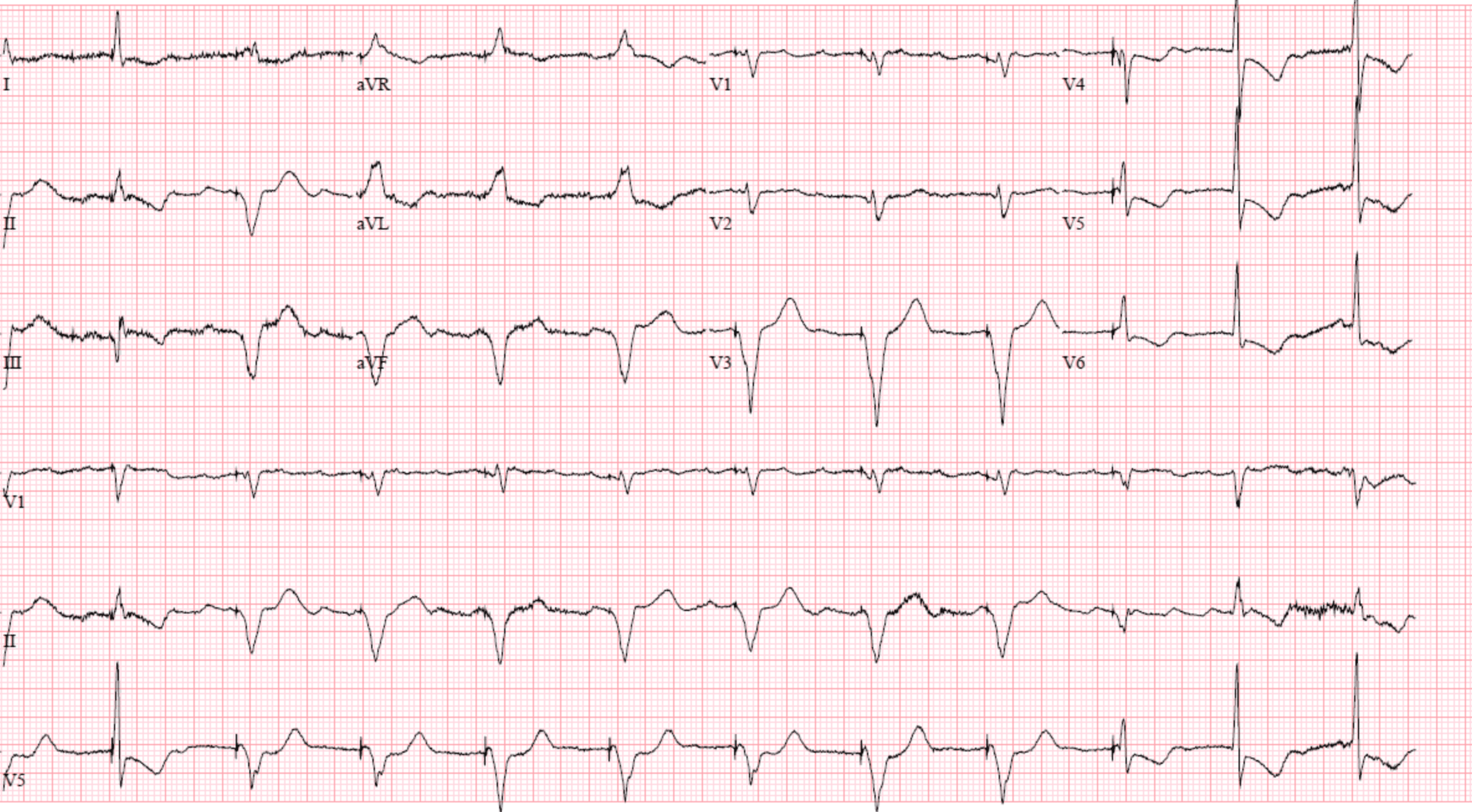 Cureus | Permanent Pacemaker Placement Secondary to Remdesivir Induced ...