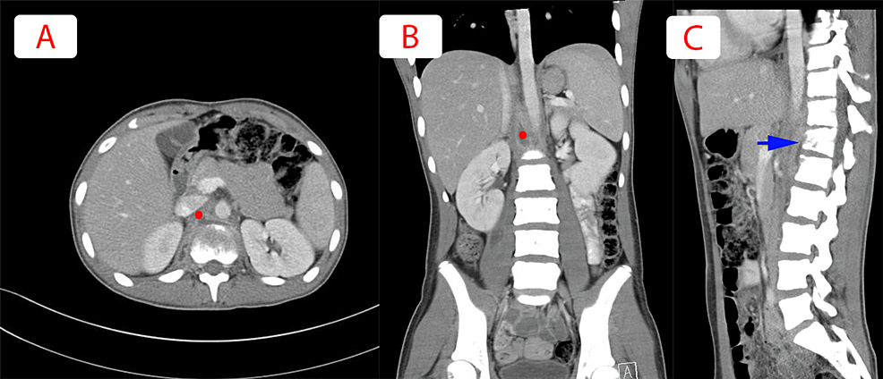 (A)-Coronal,-(B)-axial,-and-(C)-sagittal-views-of-abdomen-and-pelvis-CT-scan.-The-red-circle-localizing-the-significant-interval-resolution-of-the-right-psoas-and-retroperitoneal-collection-against-T12-L1.-Blue-arrow-showing-underlying-reduction-in-the-height-of-T12-vertebra-with-irregularity-of-endplates-and-lucencies-within-the-vertebral-body-and-along-the-anterio-superior-aspect-of-L1-vertebra-with-slightly-reduced-interval-raising-the-suspicion-for-spondylodiscitis.