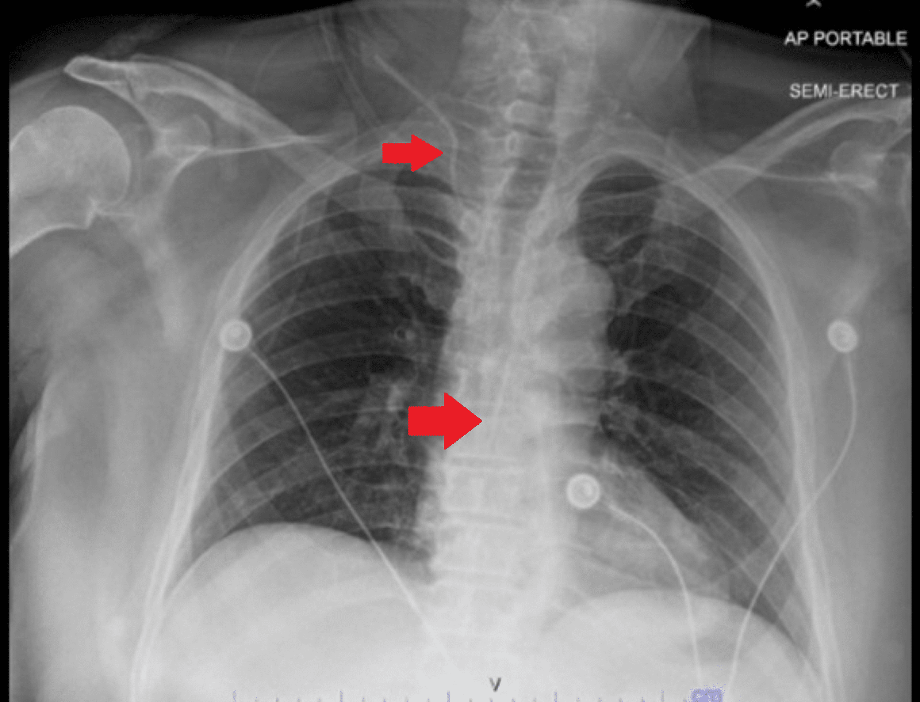 Cureus Central Venous Catheter Placement Gone Awry A Case Report of