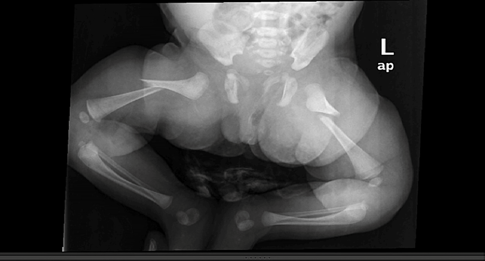 X-ray-from-the-emergency-room-showing-a-bilateral-fracture-of-the-shaft-of-the-femur.