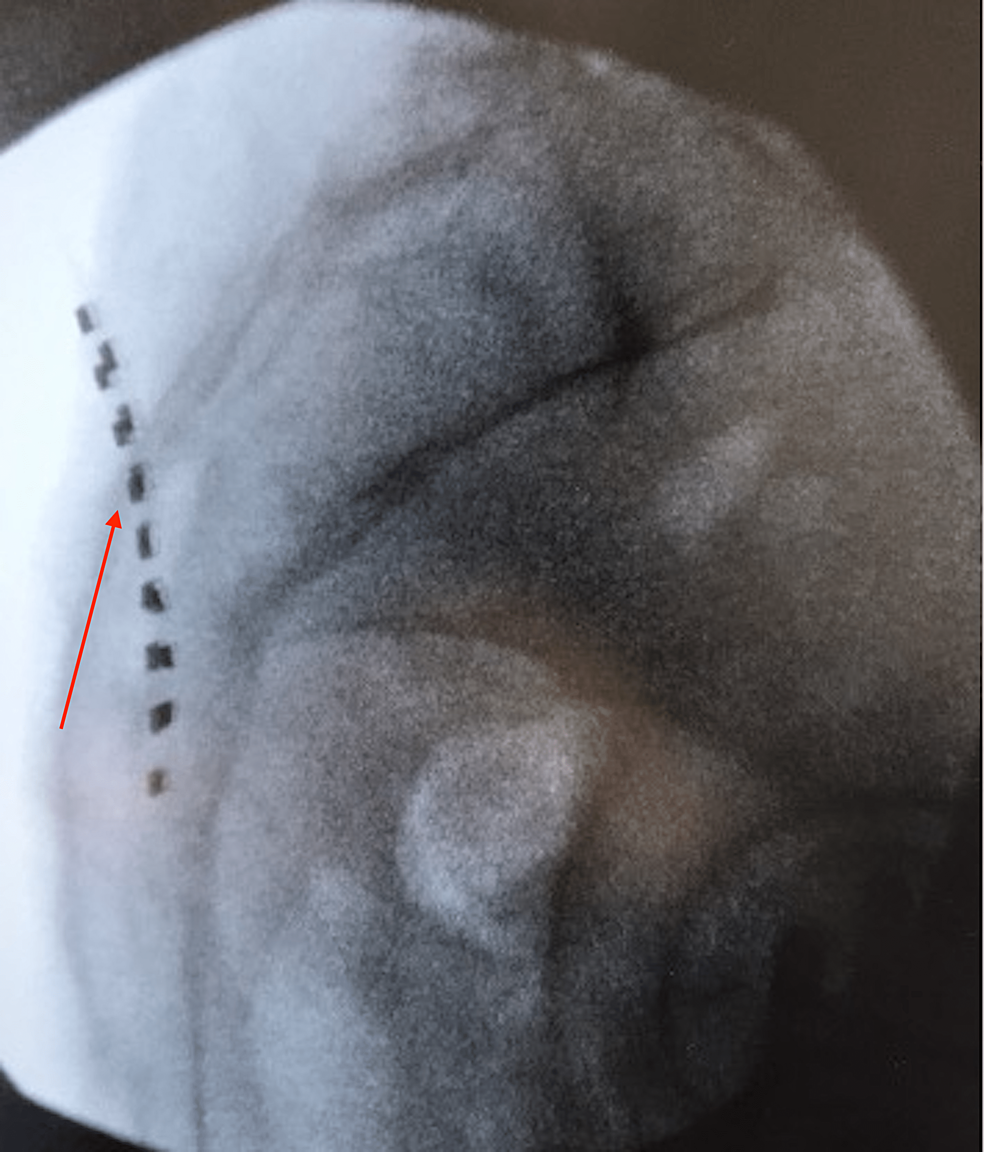 Cureus Successful Use Of Subcutaneous Stimulation For Bilateral 