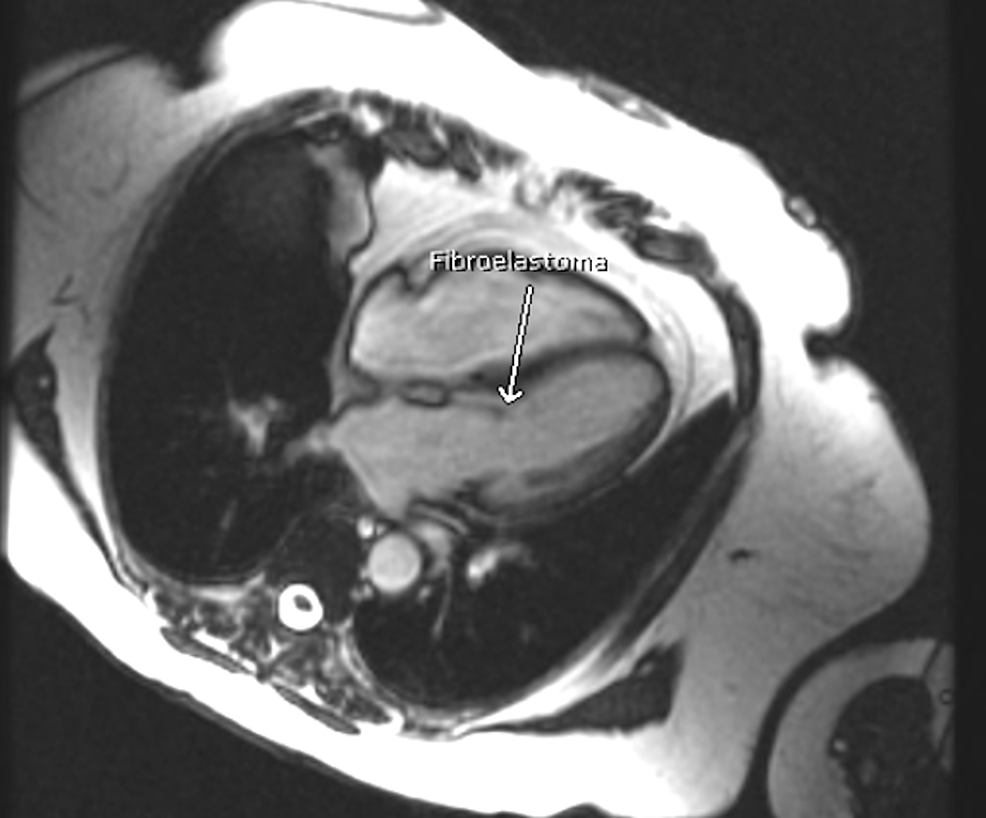 Anterior Mitral Leaflet