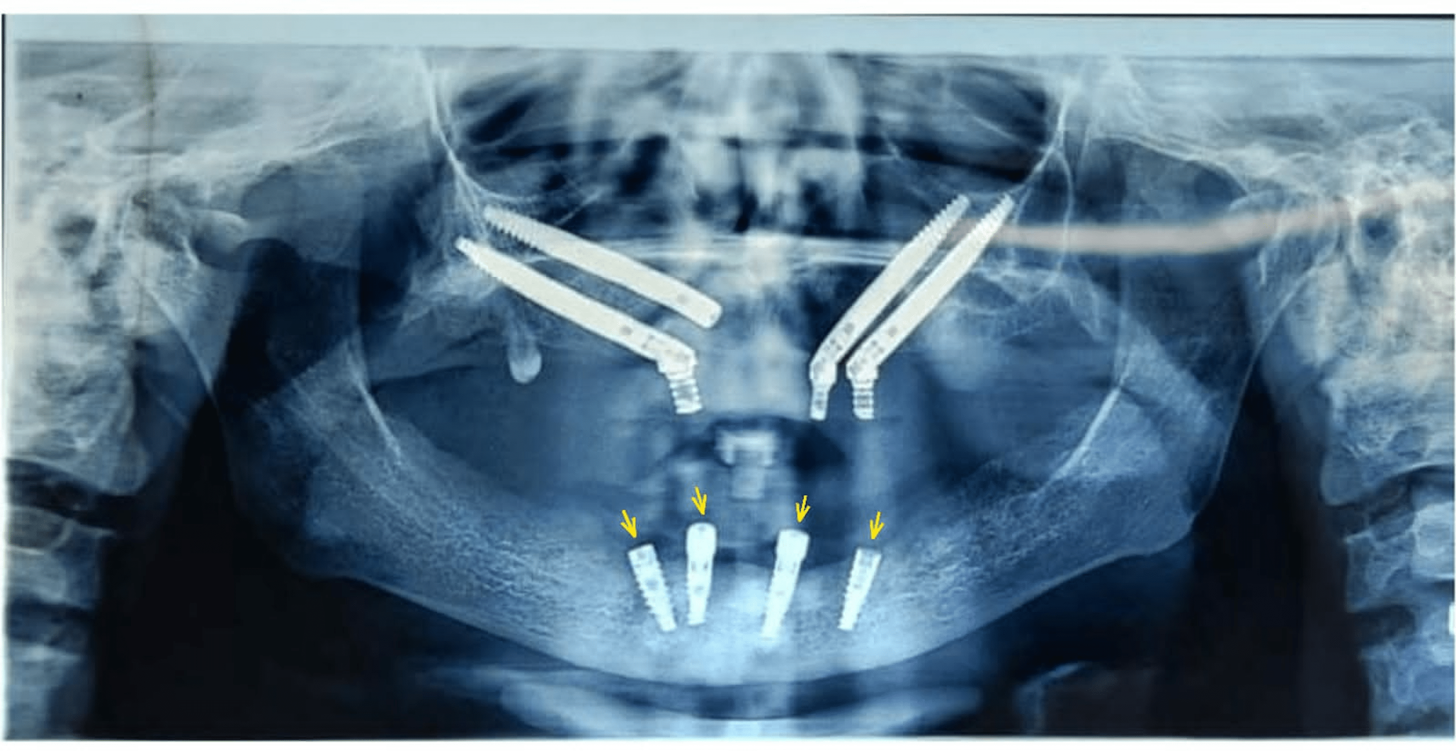 Cureus Treatment Intricacies In Mandibular Implant Supported