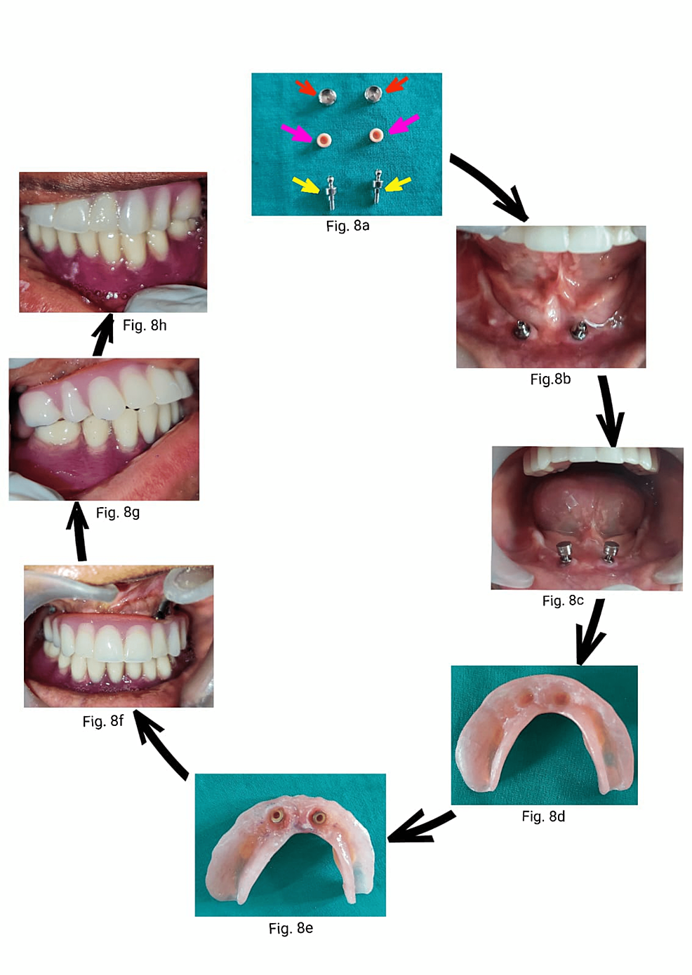 Treatment Intricacies In Mandibular Implant Supported Rehabilitation Of