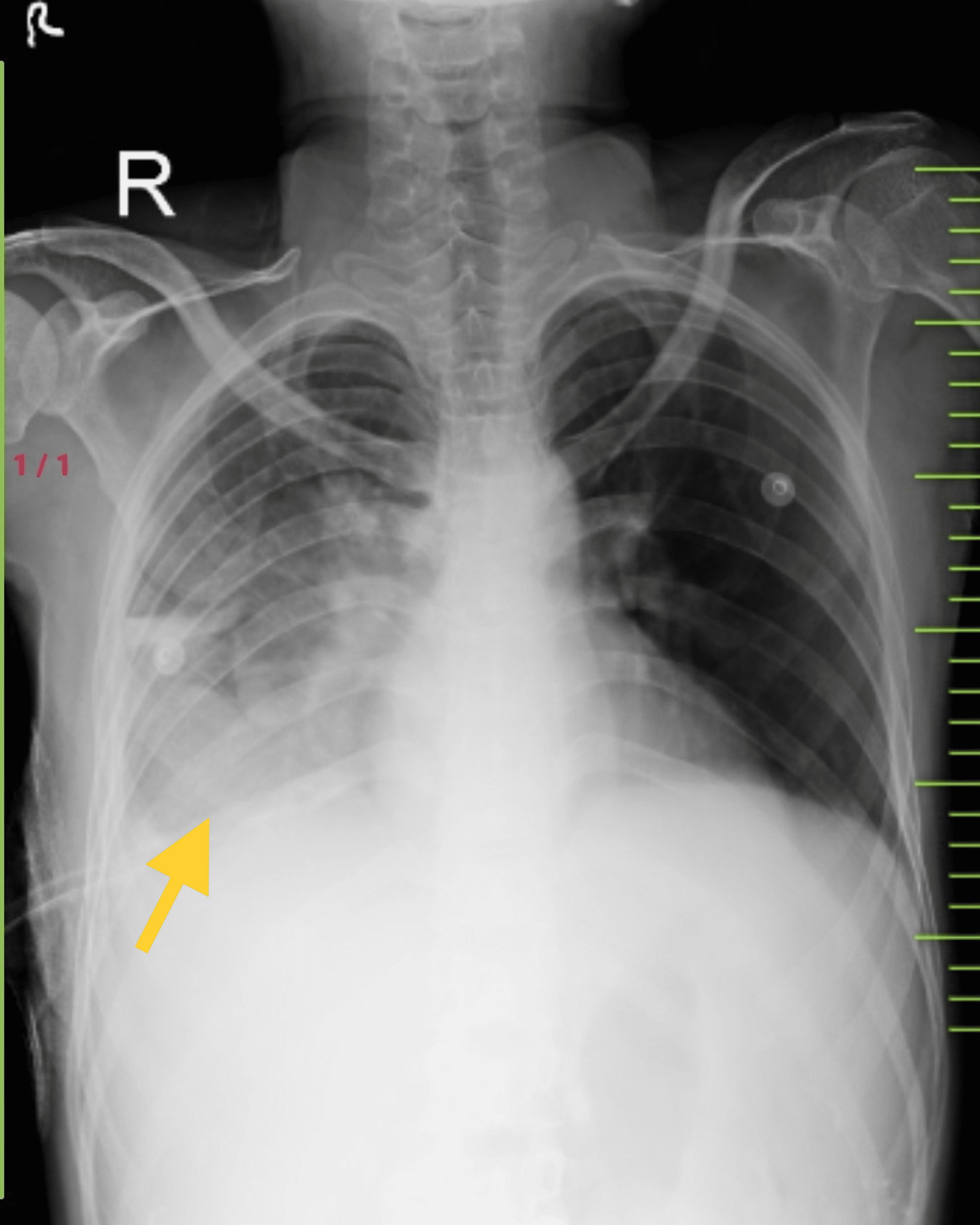DrugResistant (DR) Tubercular Pleural Effusion A Rare Case Cureus