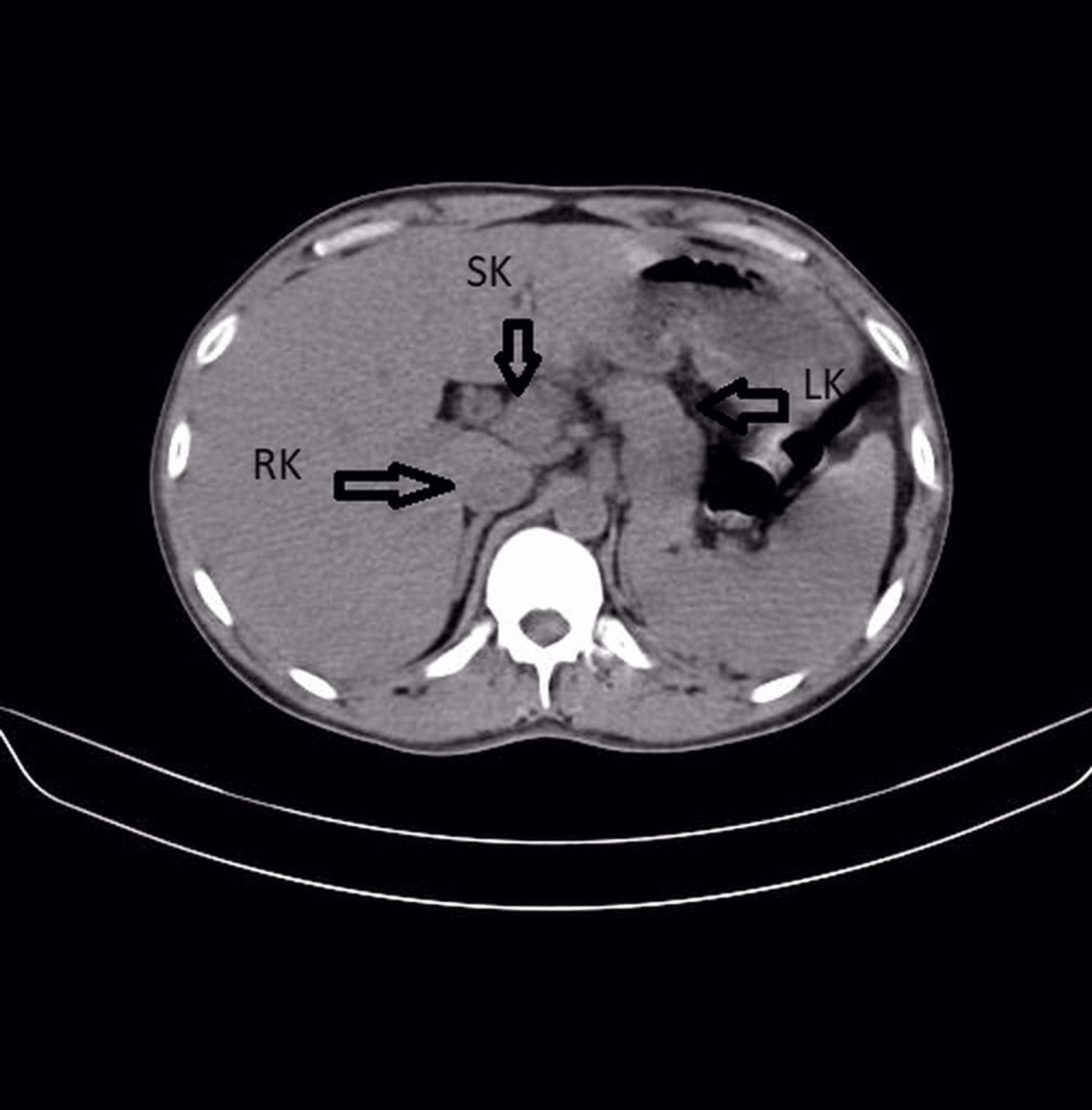 Cureus Supernumerary Kidney (Triple Kidney) With Horseshoe Malformation A Case Report