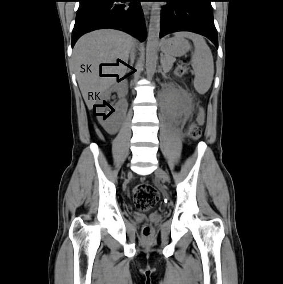Supernumerary Kidney (Triple Kidney) With Horseshoe Malformation A