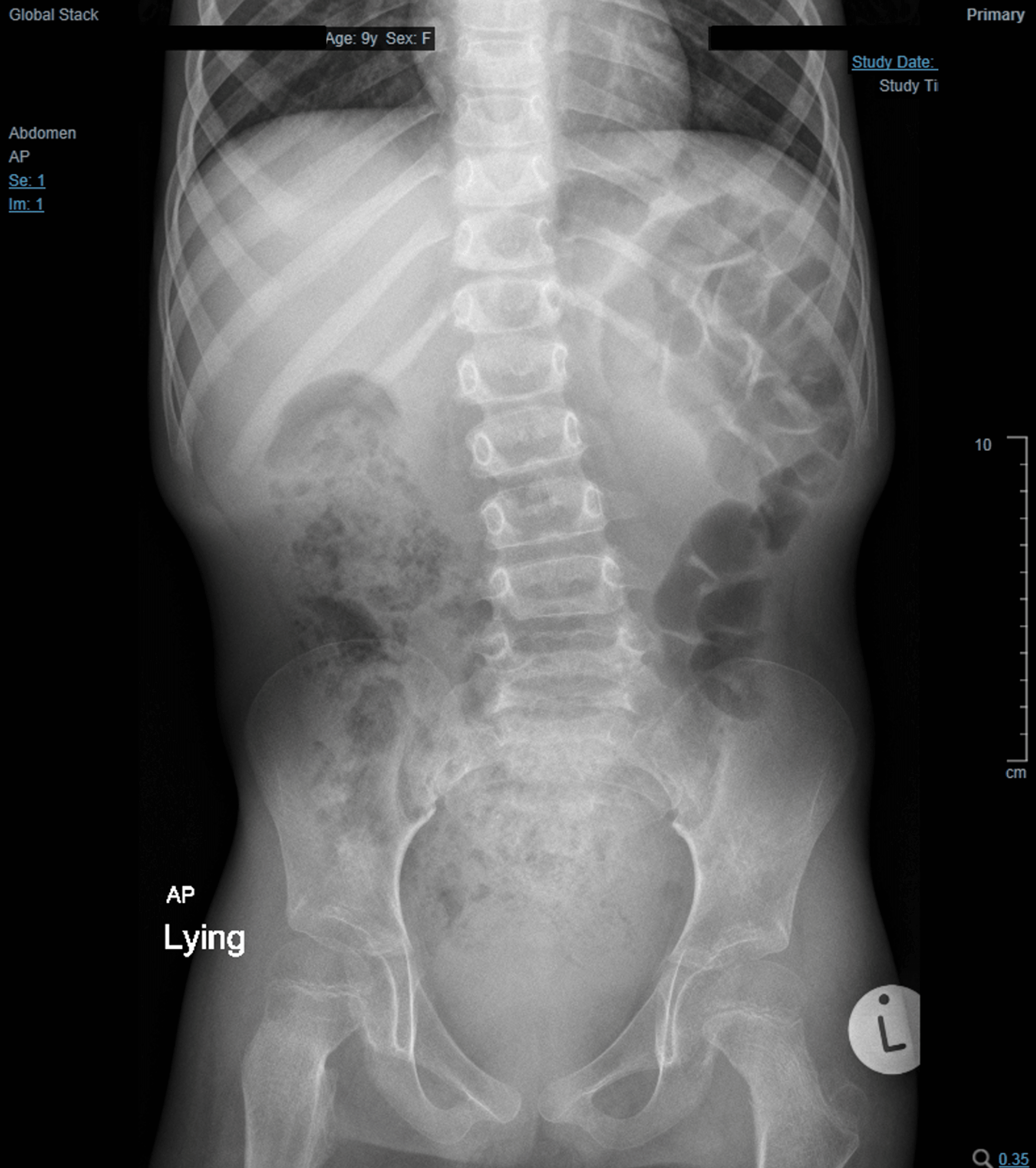 Cureus Large Bowel Obstruction Secondary to a Fecaloma in a Child With Cerebral Palsy