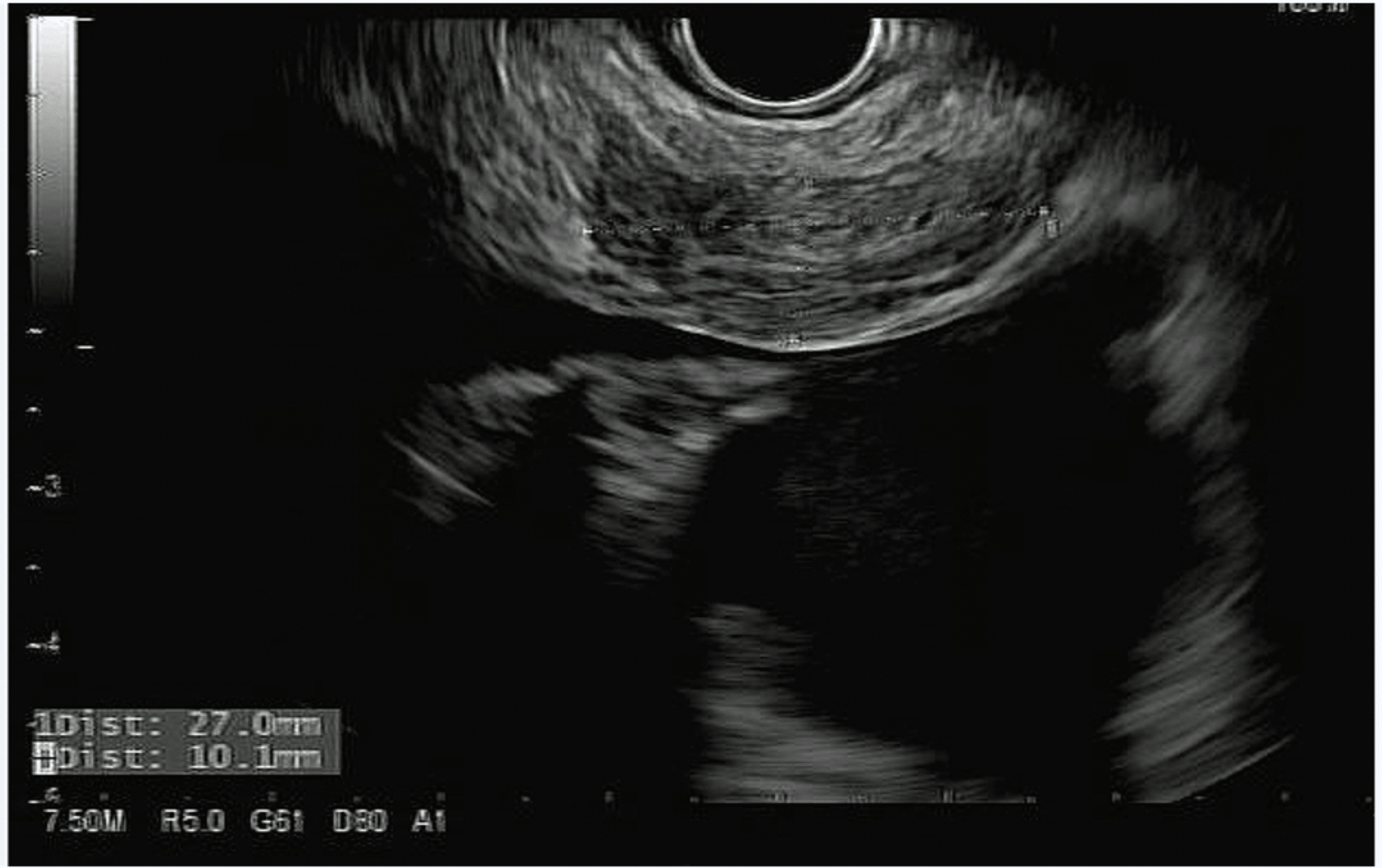 Cureus Simultaneous Use of Endobronchial and Endoscopic Ultrasound