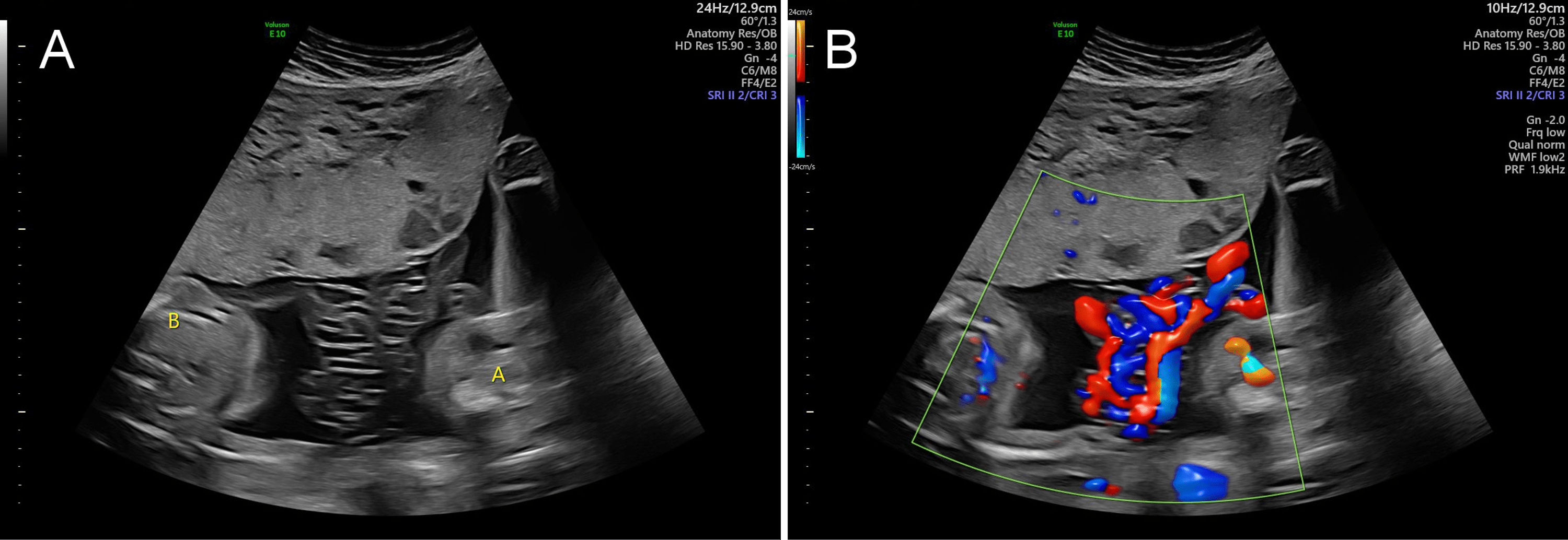 Cureus Inpatient Management of a Monoamniotic Twin Pregnancy