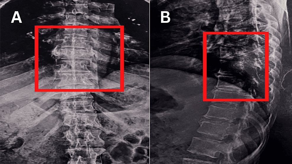 Displays-a-one-year-old-spine-X-ray-showing-a-D7-wedge-compression-fracture.-(A)-Postero-anterior-view-(B)-Lateral-view