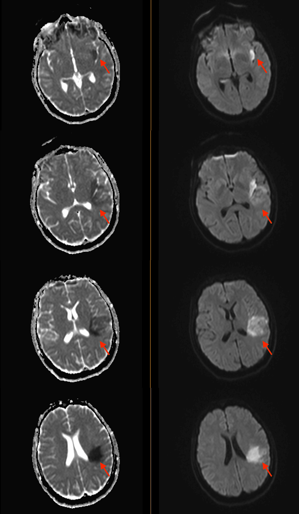 MRI-of-the-brain-showing-early-subacute-ischemia-in-the-left-insula-posteriorly-and-frontoparietal-lobe-in-the-middle-cerebral-artery-territory,-without-any-signs-of-hemorrhage,-midline-shift-or-cerebral-edema.