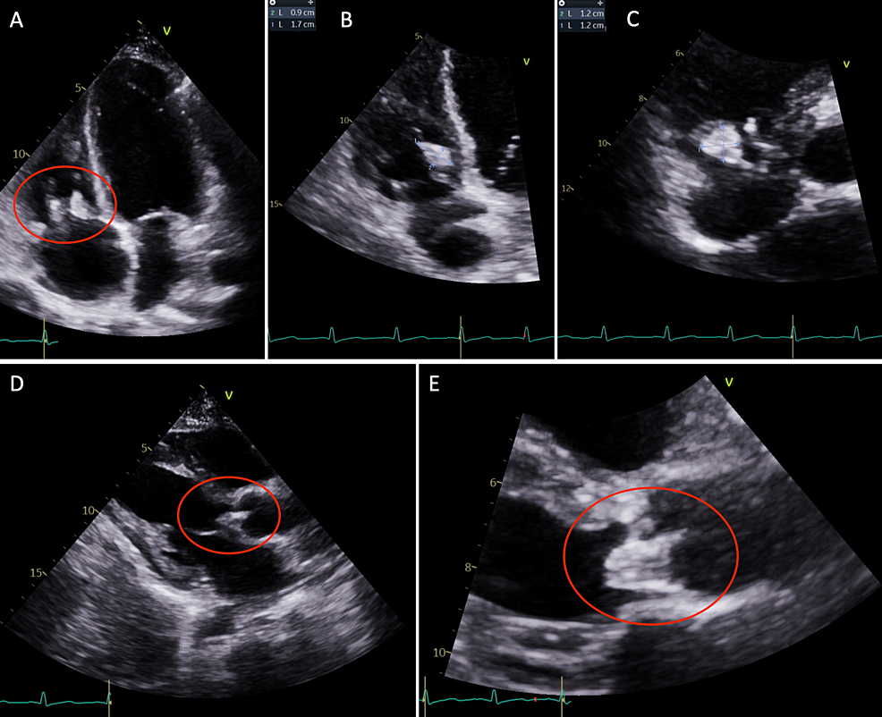 Repeat-transthoracic-echocardiogram-revealing-the-increasing-size-of-valvular-vegetations.-Apical-four-chamber-view-(A)-and-magnified-views-of-the-tricuspid-valve-(B)-and-(C)-showing-a-1.2-cm-×-1.2-cm-echodensity-attached-to-the-anterior-leaflet-and-a-0.9-cm-×-1.7-cm-echodensity-attached-to-the-septal-leaflet.-The-parasternal-long-axis-view-(D)-and-magnified-view-of-the-aortic-valve-(E)-showing-a-1.7-cm-×-1.2-cm-echodensity-on-the-noncoronary-cusp-of-the-aortic-valve.