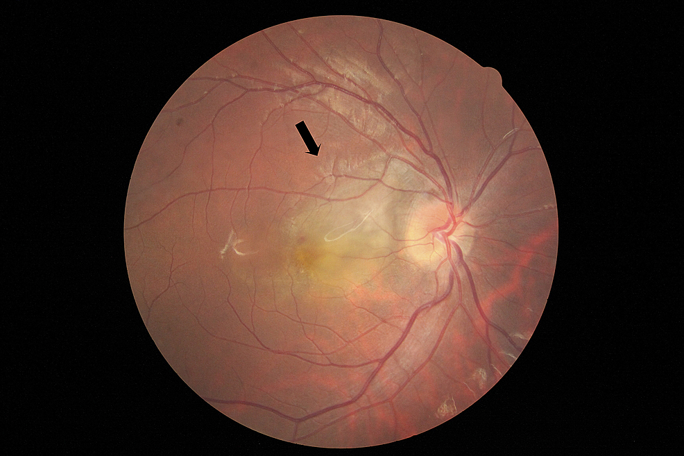 Fundus-photograph-of-the-right-eye