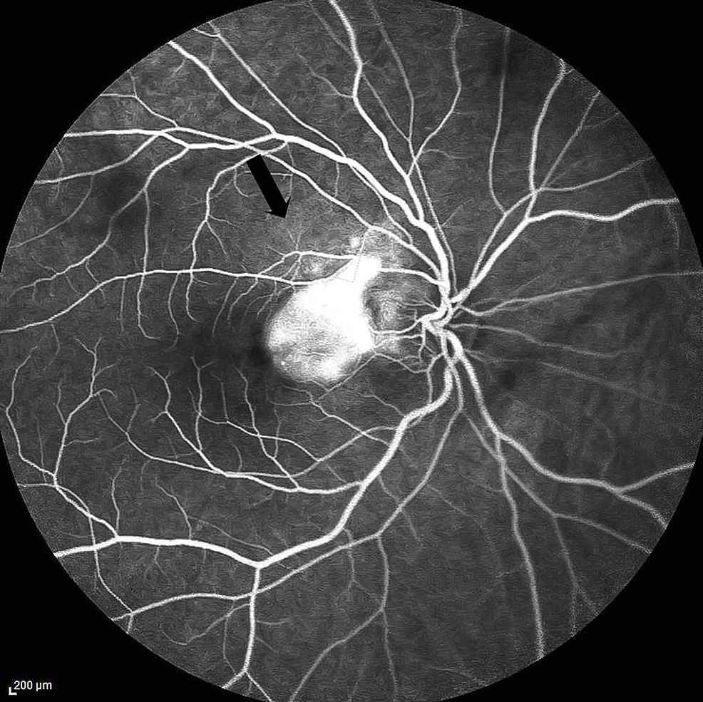 Fundus-fluorescein-angiography-of-the-right-eye-in-the-late-phase