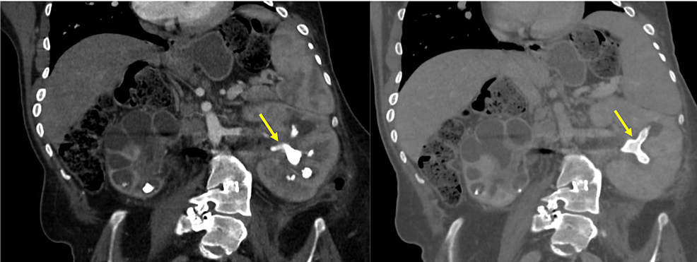 Cureus | A Novel Nonvascular Application of the Steerable Microcatheter