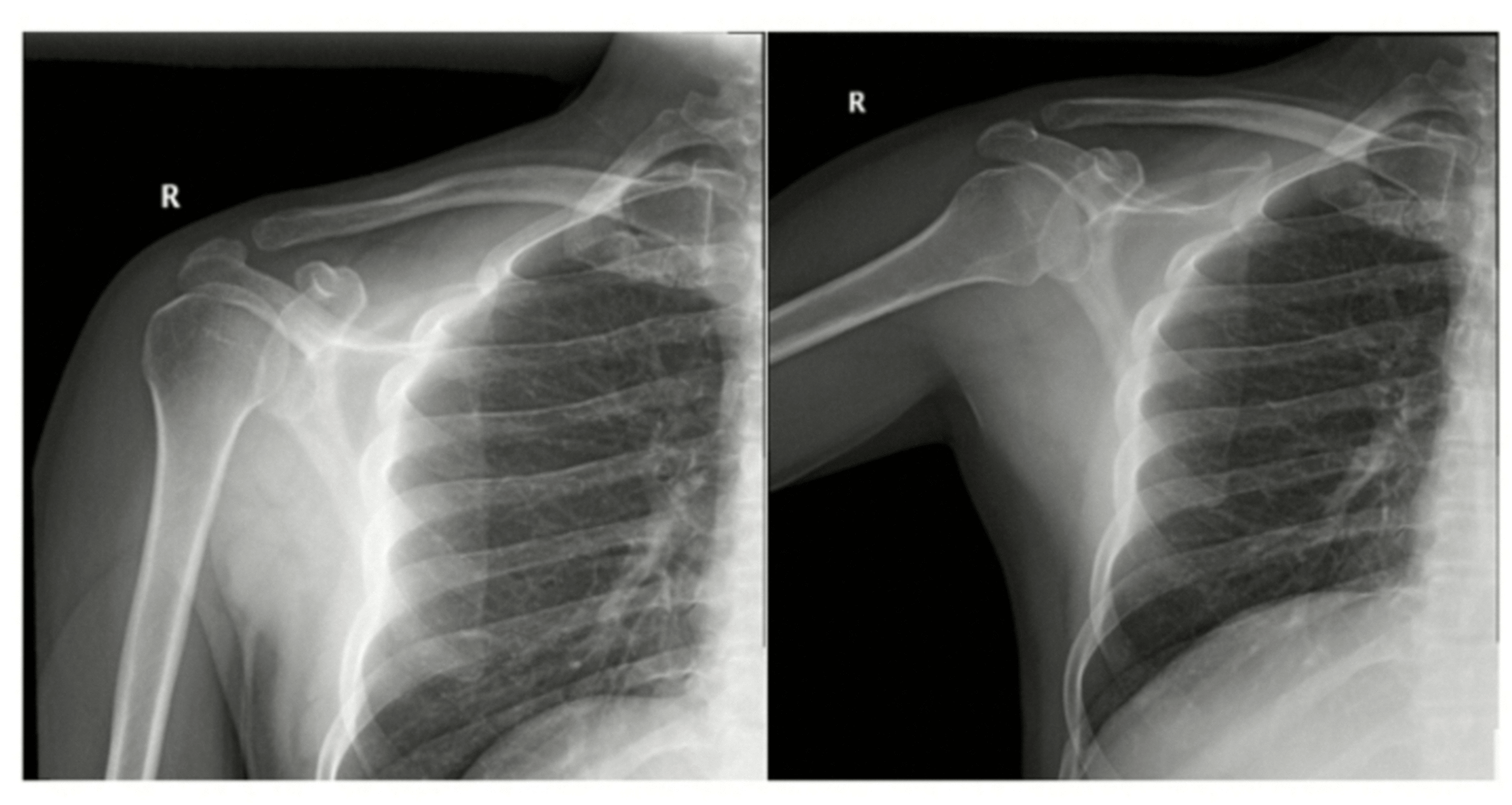 Cureus Acute Upper Extremity Vein Thrombosis in Recurrent Shoulder