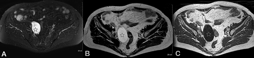 Cureus Low Grade Appendiceal Mucinous Neoplasm Presenting As Adnexal Mass A Case Report