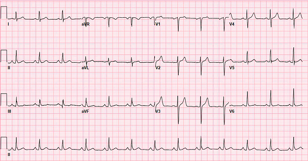 Anomalous Origin of the Right Coronary Artery From the Left Coronary ...