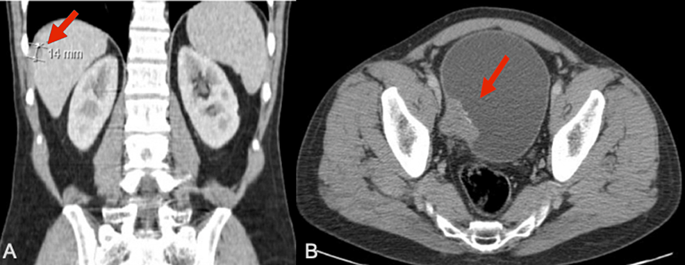 cureus-an-unexpected-and-unpredictable-emergence-of-muscle-invasive