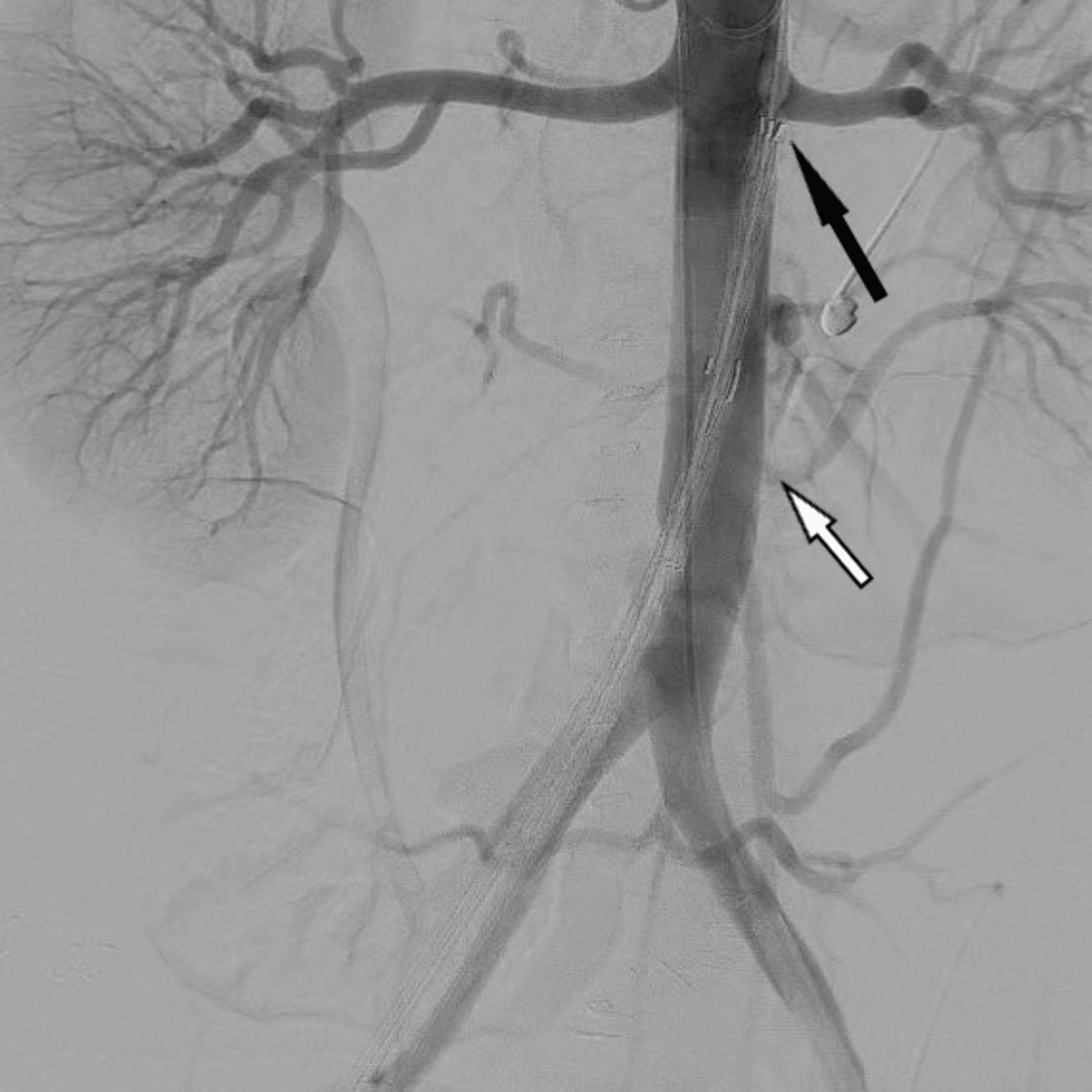 Cureus Endovascular Aortic Repair After Abdominal Aortic Injury in a
