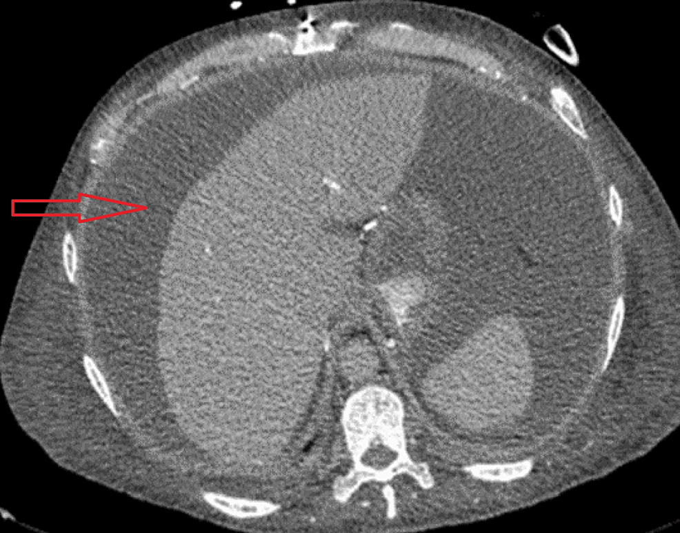 Axial-image-of-contrast-enhanced-CT-abdomen-with-massive-ascites-(horizontal-red-arrow).