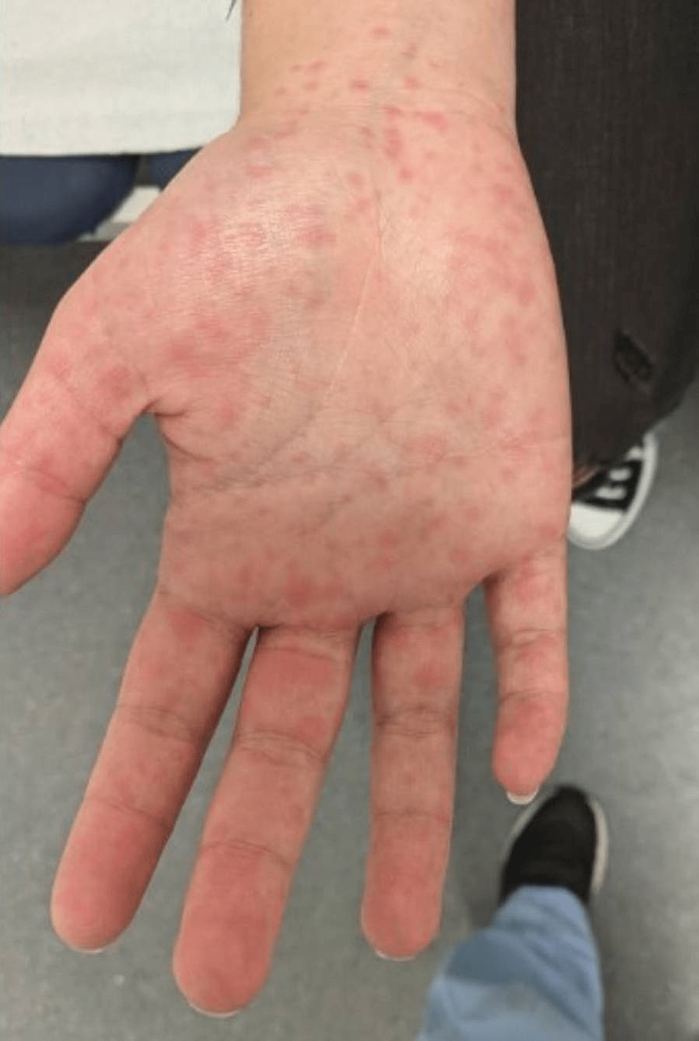 eosinophilia-in-amoxicillin-induced-rash-in-infectious-mononucleosis