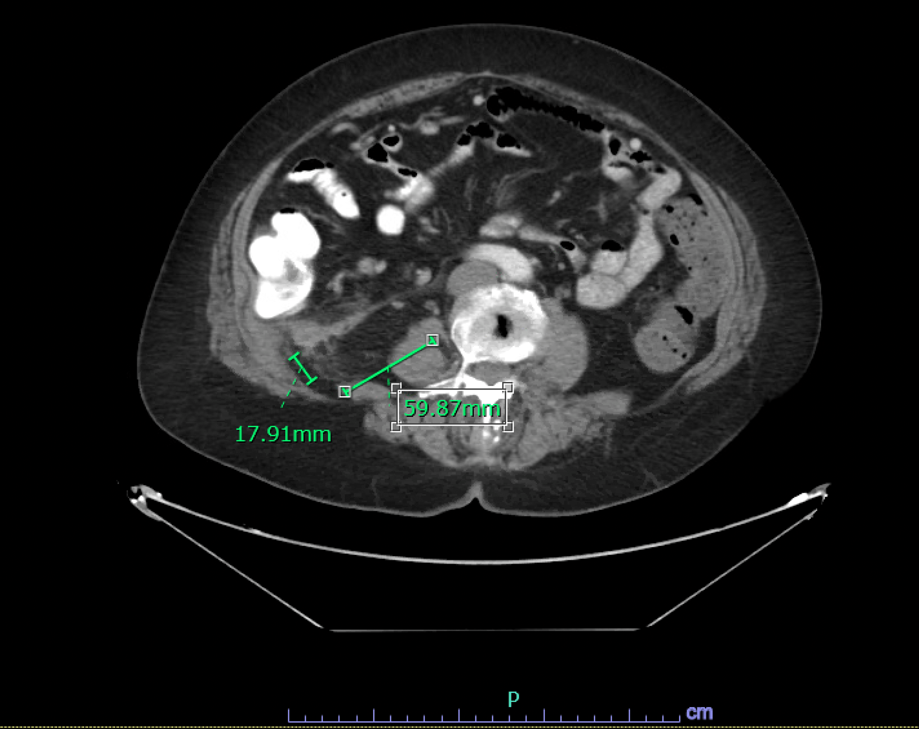 axial-image-measurements-a-anterior-to-posterior-diameter-of-the