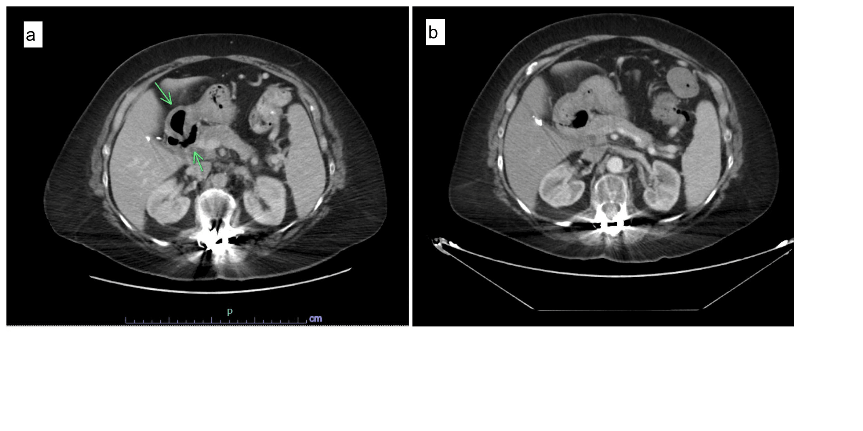 Cureus Dropped Gallstone Mimicking Retroperitoneal Tumor 5 Years After Laparoscopic